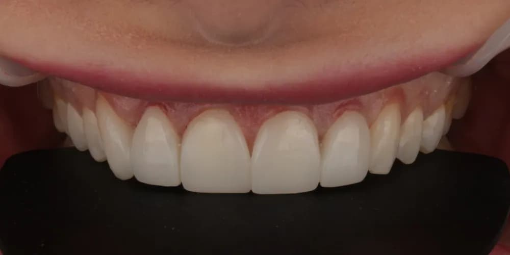 After: a patient's smile, treated with composite bonding