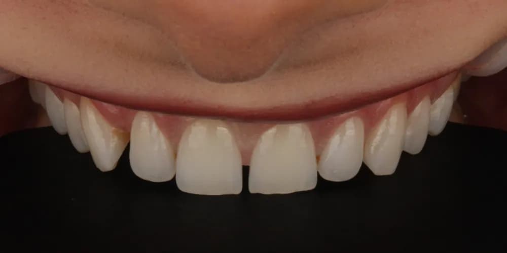 Before: a patient's smile, treated with composite bonding