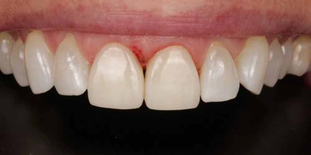 After: a patient's upper front teeth, treated with composite bonding