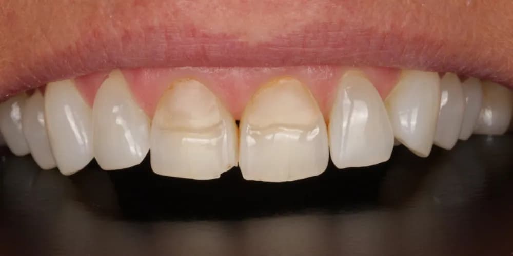 Before: a patient's upper front teeth, treated with composite bonding