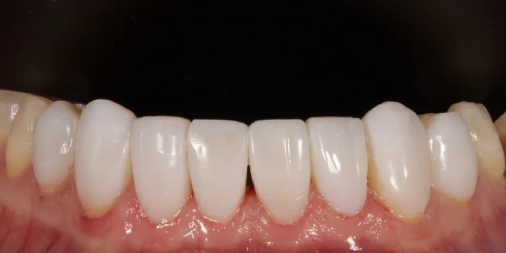 After: a patient's lower front teeth, treated with composite bonding