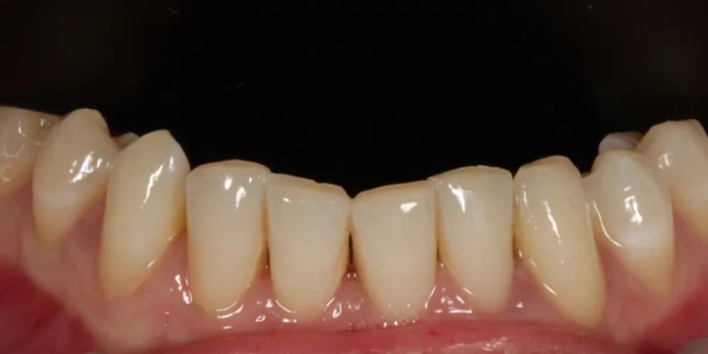 Before: a patient's lower front teeth, treated with composite bonding