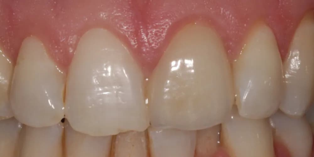 After: a chipped upper front tooth, repaired with composite bonding