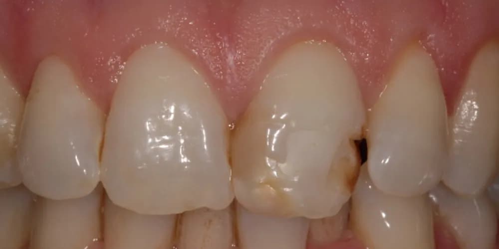 Before: a chipped upper front tooth, repaired with composite bonding