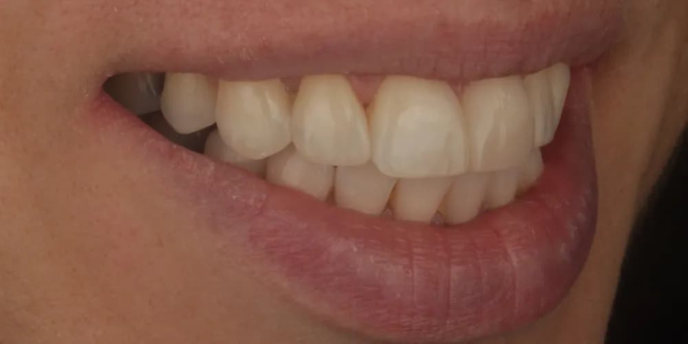 After: a patient's smile from the side, treated with composite bonding