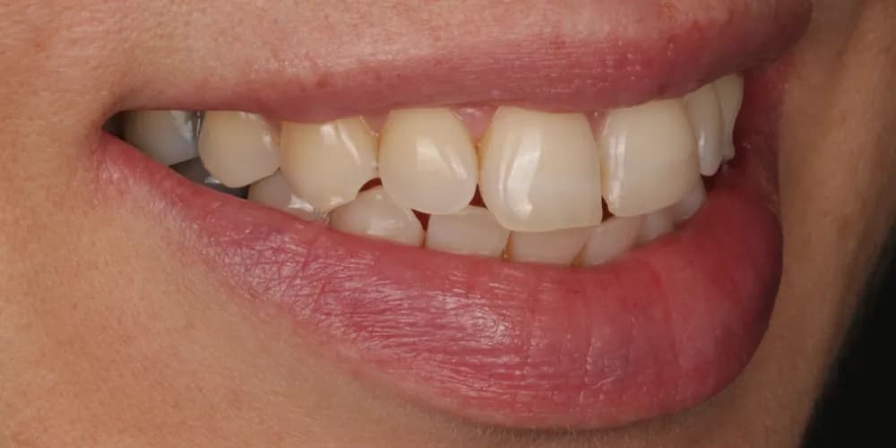 Before: a patient's smile from the side, treated with composite bonding