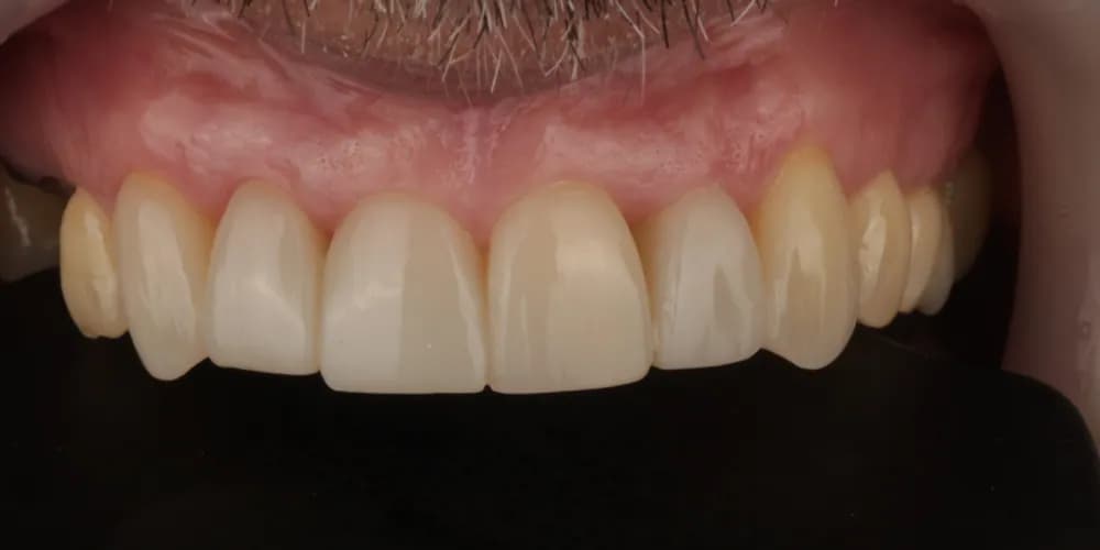 After: worn, discoloured front teeth, restored with composite bonding