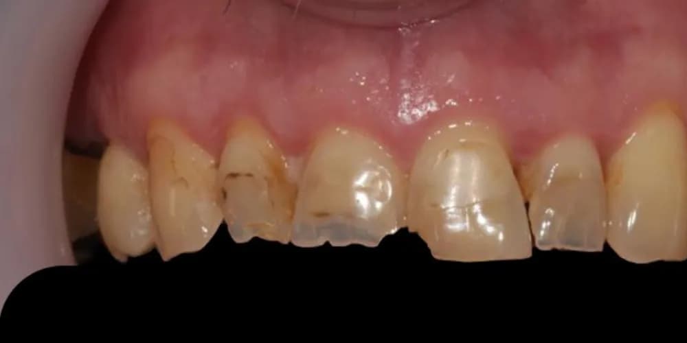 Before: worn, discoloured front teeth, restored with composite bonding