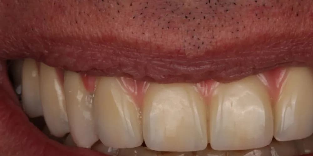 After: a patient's smile with missing teeth replaced by dental implants