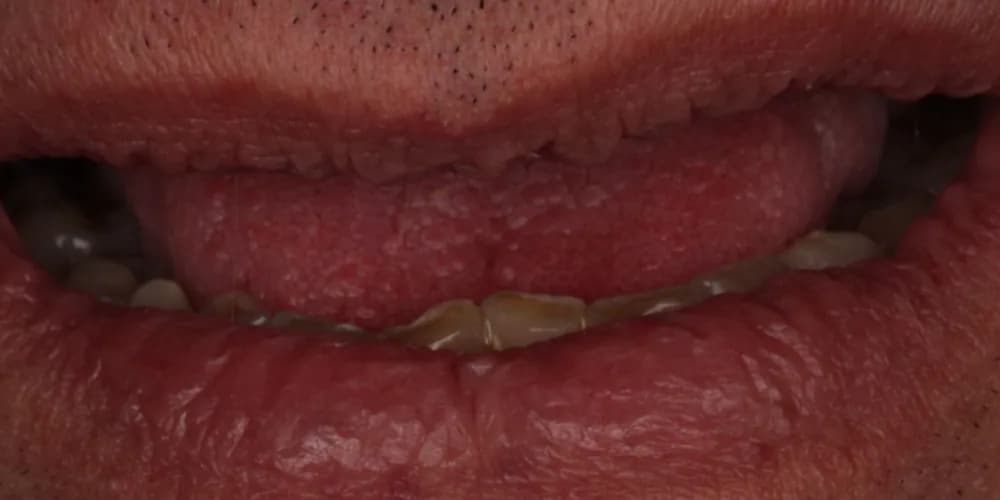Before: a patient's smile with missing teeth replaced by dental implants