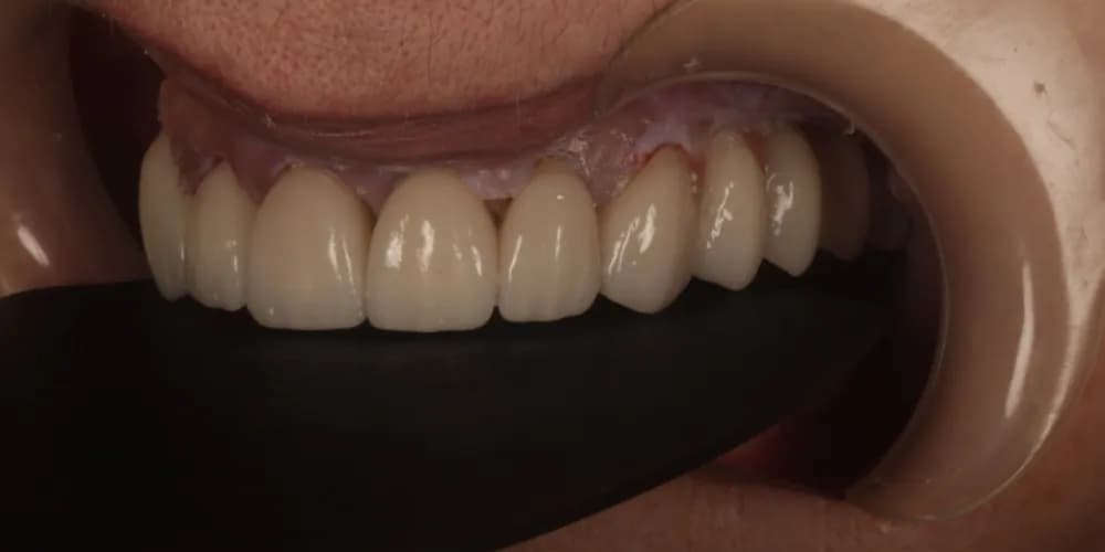 After: a patient's teeth, restored with implants and crowns