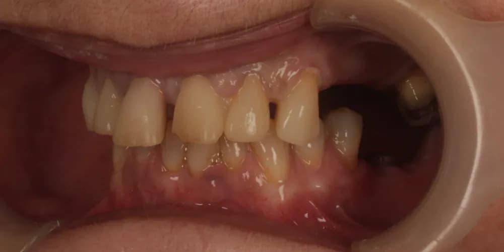 Before: a patient's teeth, restored with implants and crowns