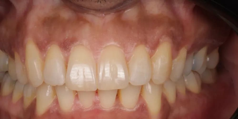 After: crowded front teeth, straightened with Invisalign
