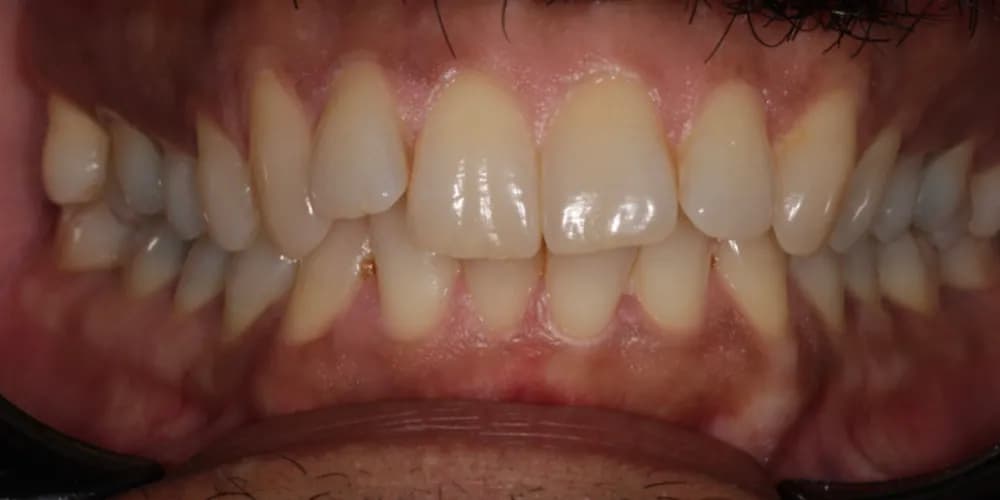 Before: crowded front teeth, straightened with Invisalign