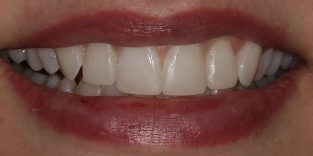 After: a patient's smile after Invisalign, whitening and composite bonding