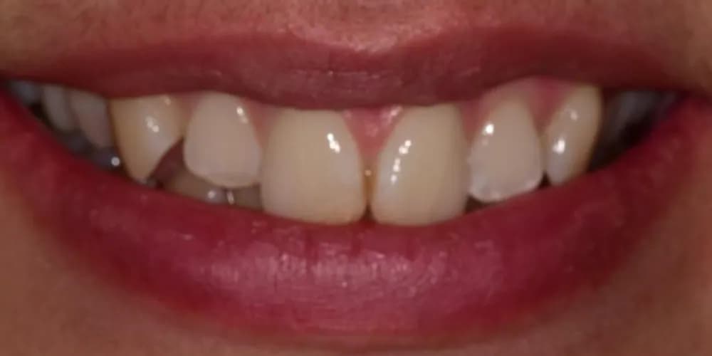 Before: a patient's smile after Invisalign, whitening and composite bonding