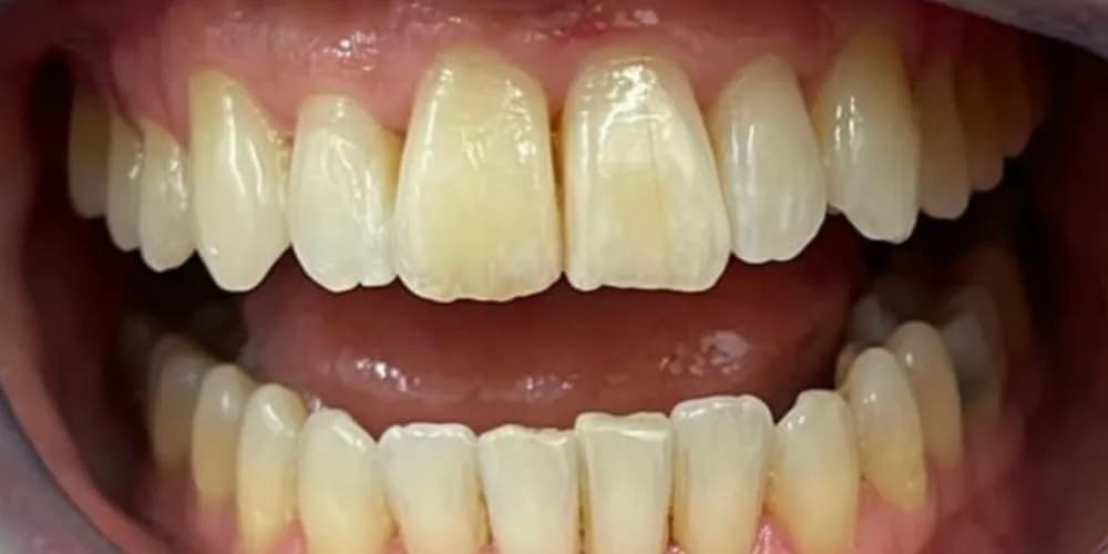 After: a patient's front teeth, straightened with Invisalign