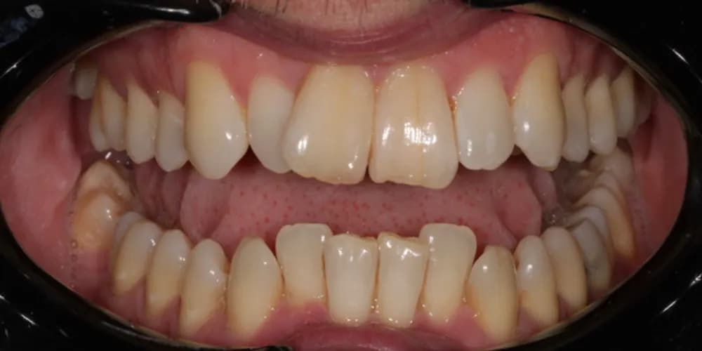 Before: a patient's front teeth, straightened with Invisalign