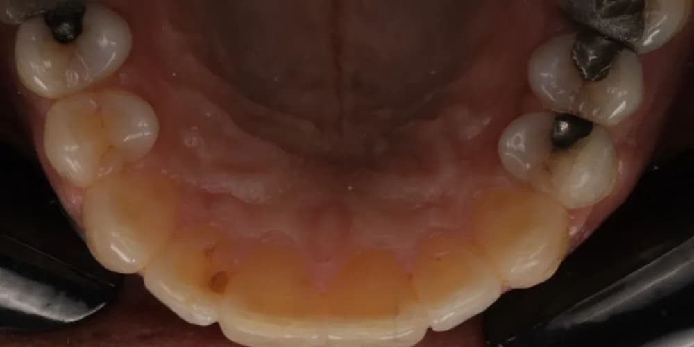 After: the lower teeth seen from above, straightened with Invisalign