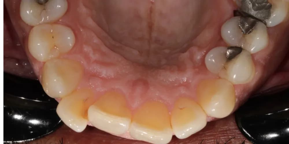 Before: the lower teeth seen from above, straightened with Invisalign