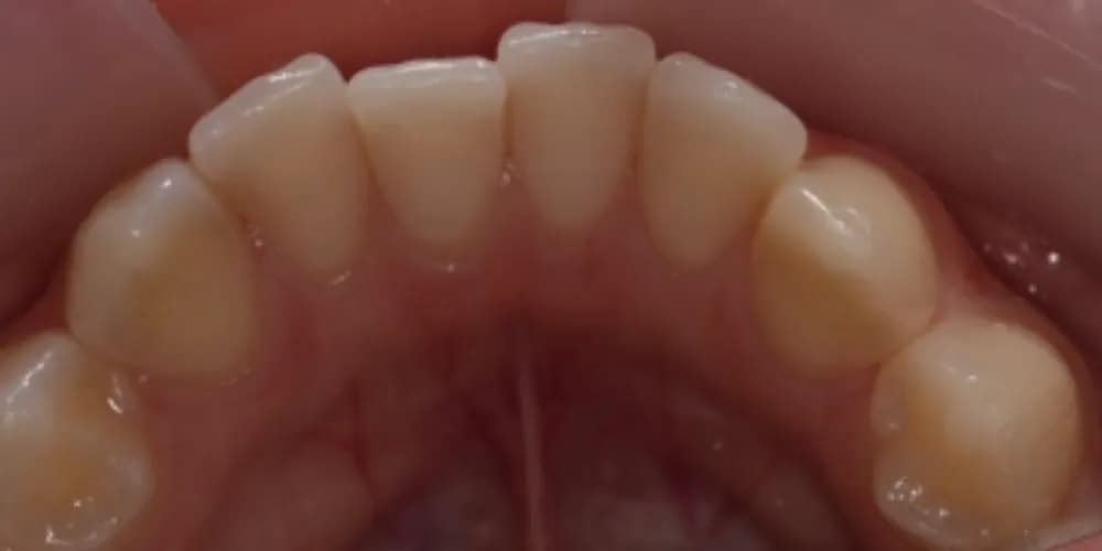 Before: the upper teeth seen from below, straightened with Invisalign