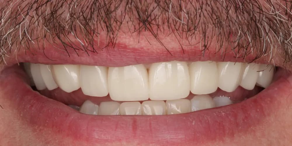 After: a patient's smile, transformed with porcelain veneers