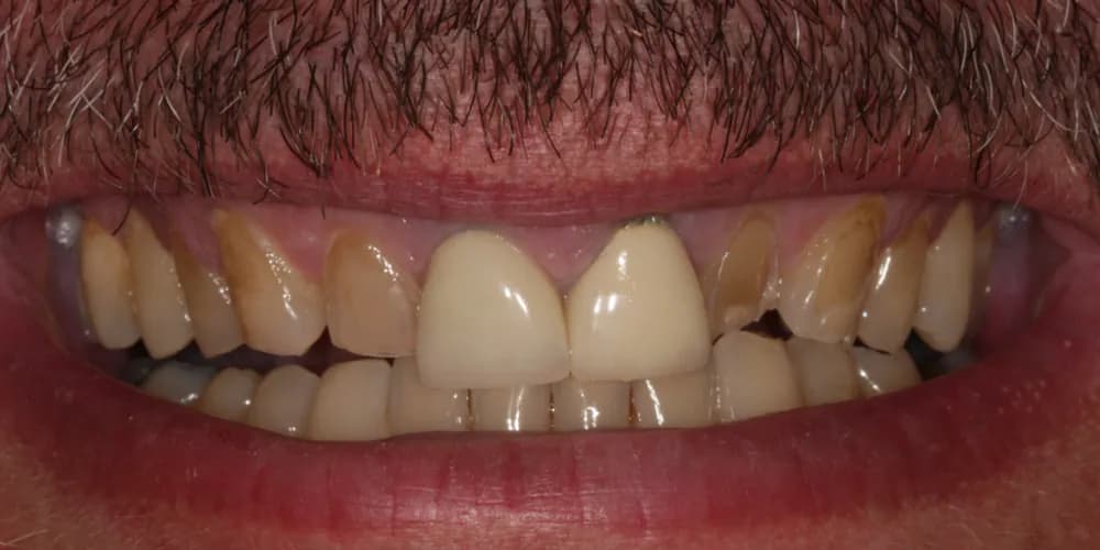 Before: a patient's smile, transformed with porcelain veneers