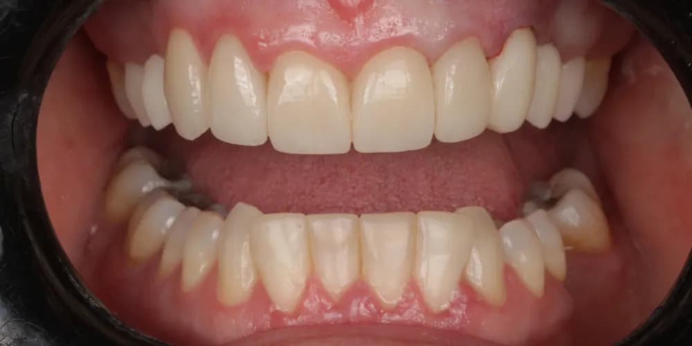 After: a patient's upper and lower teeth, transformed with porcelain veneers