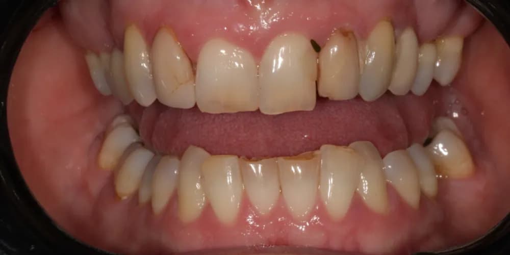 Before: a patient's upper and lower teeth, transformed with porcelain veneers