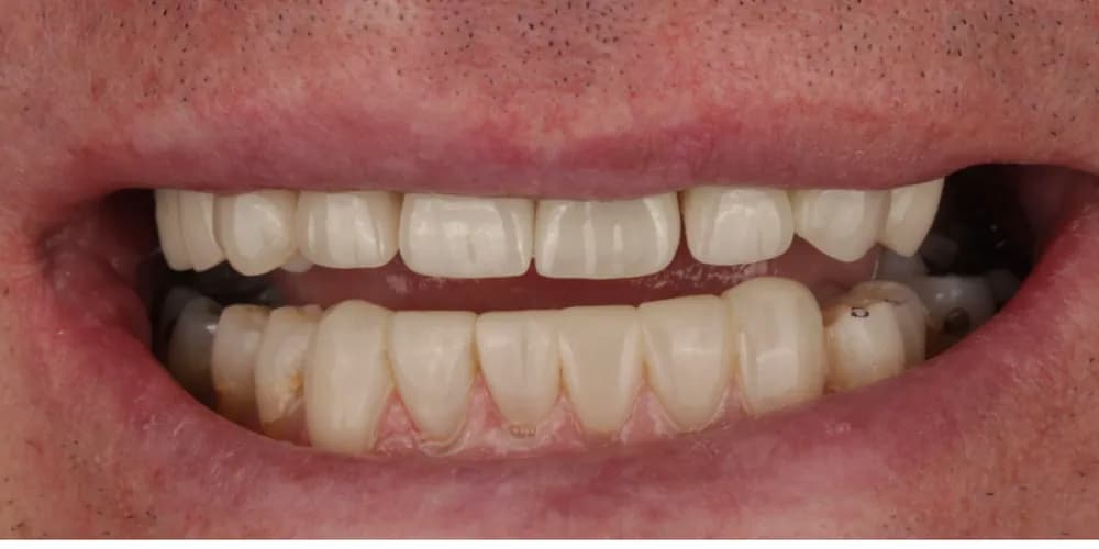 After: a patient's smile, transformed with porcelain veneers