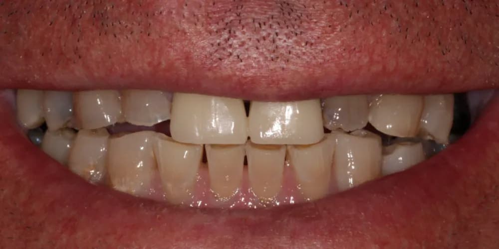 Before: a patient's smile, transformed with porcelain veneers