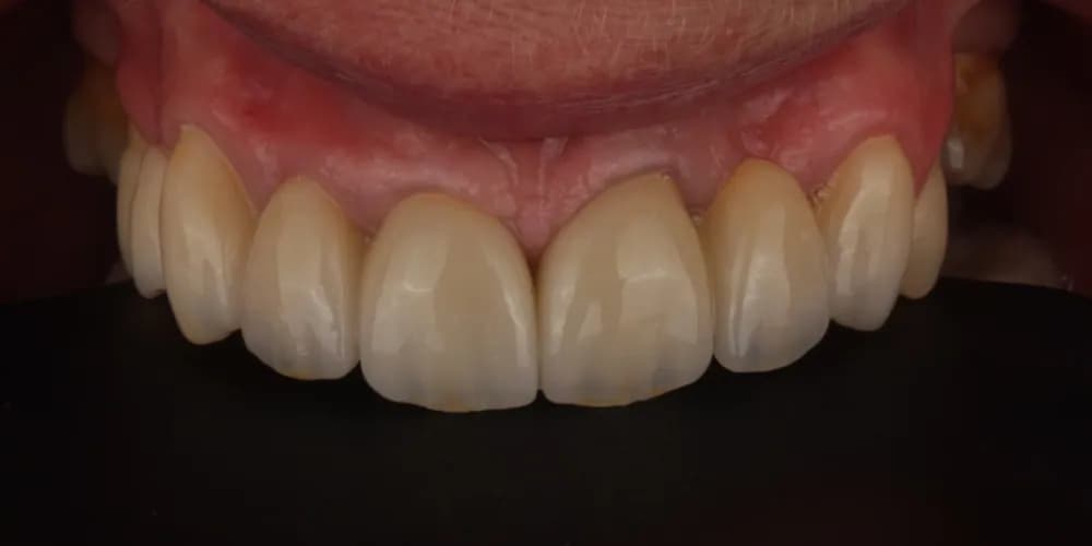 After: a patient's front teeth, restored with crowns and veneers