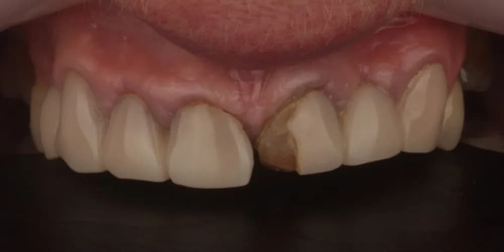 Before: a patient's front teeth, restored with crowns and veneers