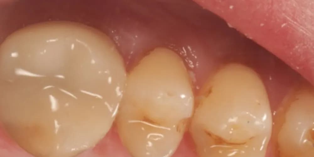 After: a badly decayed back tooth, restored with a same-day ceramic crown