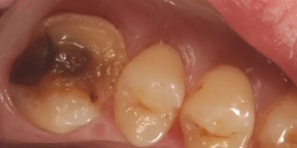 Before: a badly decayed back tooth, restored with a same-day ceramic crown