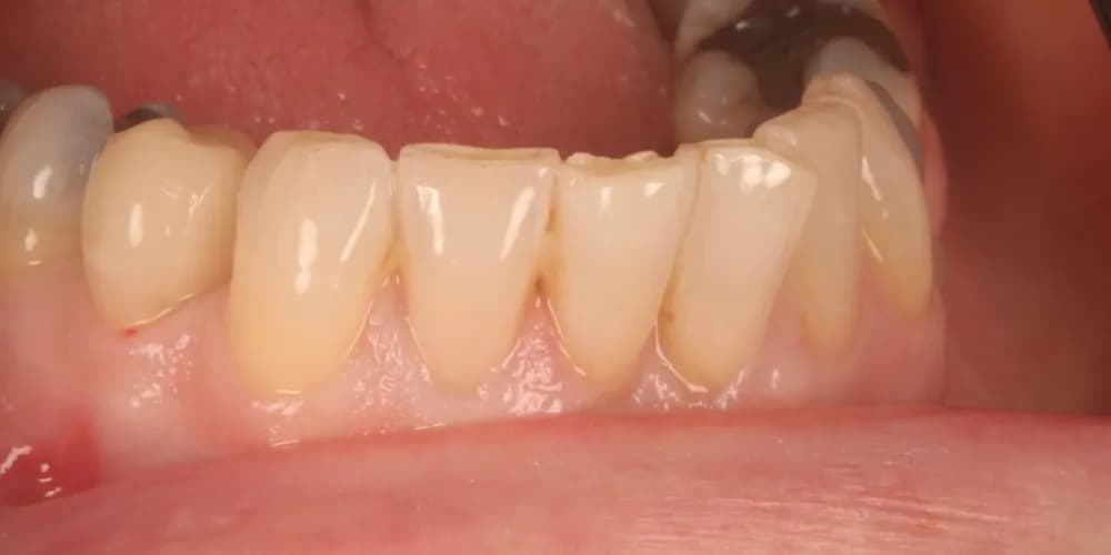 After: a broken tooth, restored with a same-day ceramic crown