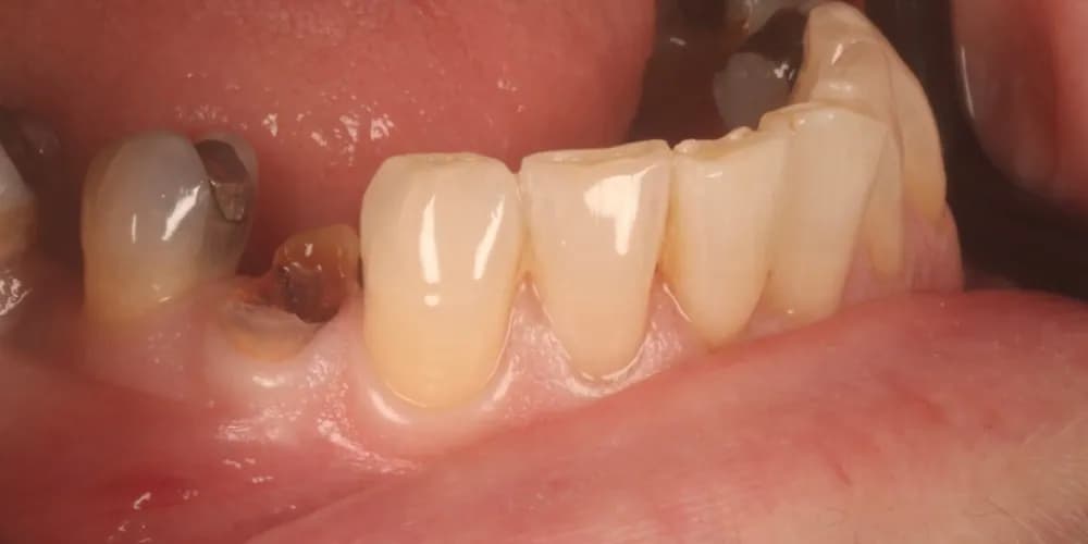 Before: a broken tooth, restored with a same-day ceramic crown