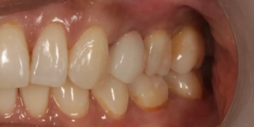 After: a damaged tooth, restored with a same-day ceramic crown