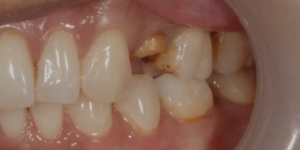 Before: a damaged tooth, restored with a same-day ceramic crown
