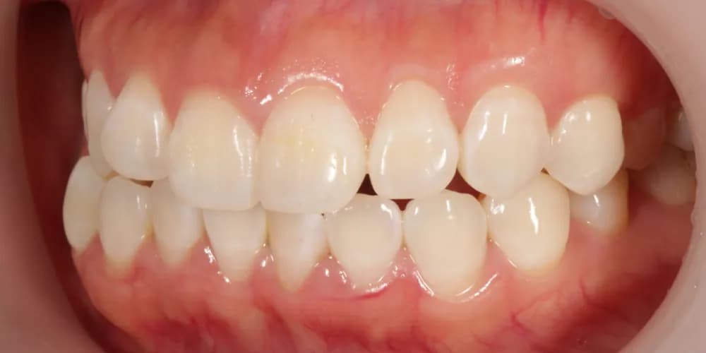 After: a patient's teeth, treated with professional whitening