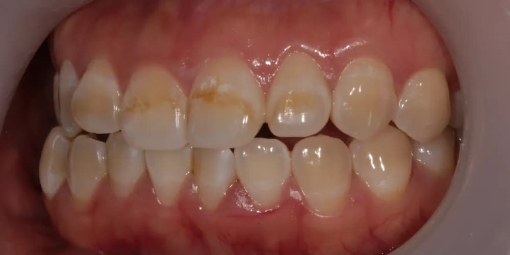 Before: a patient's teeth, treated with professional whitening