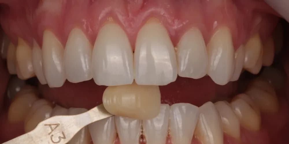 After: a patient's teeth next to an A3 shade tab, treated with professional whitening