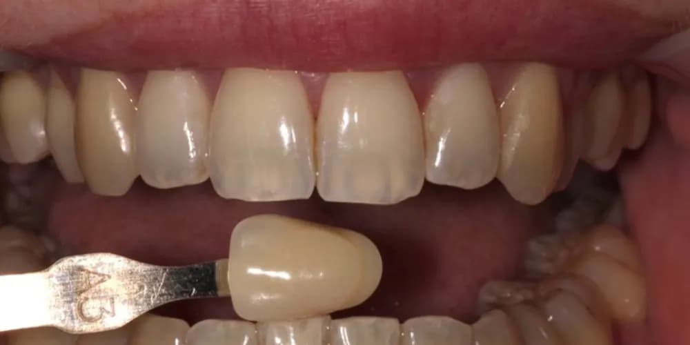 Before: a patient's teeth next to an A3 shade tab, treated with professional whitening