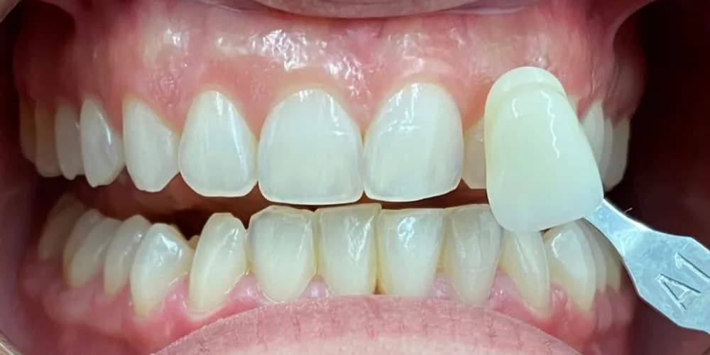 After: a patient's teeth next to a shade tab, whitened from shade A3 to A1