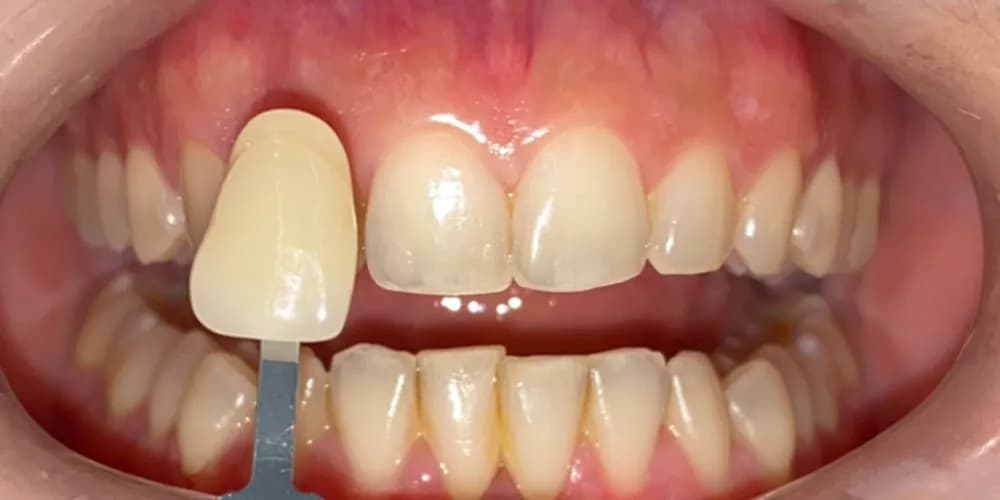 Before: a patient's teeth next to a shade tab, whitened from shade A3 to A1