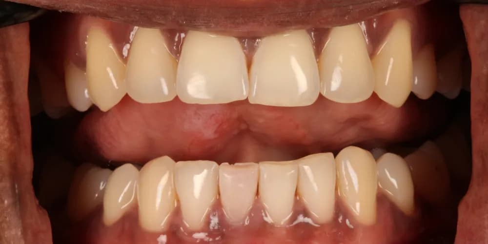After: a darkened lower front tooth, lightened with internal whitening