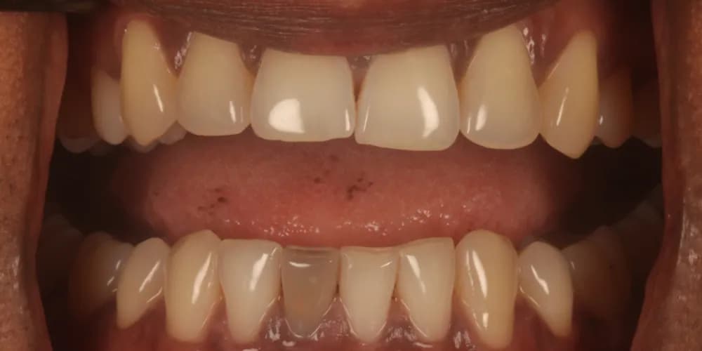Before: a darkened lower front tooth, lightened with internal whitening