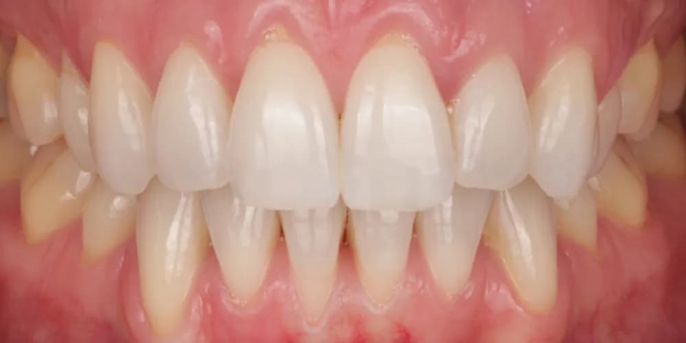 After: a patient's front teeth, treated with professional whitening