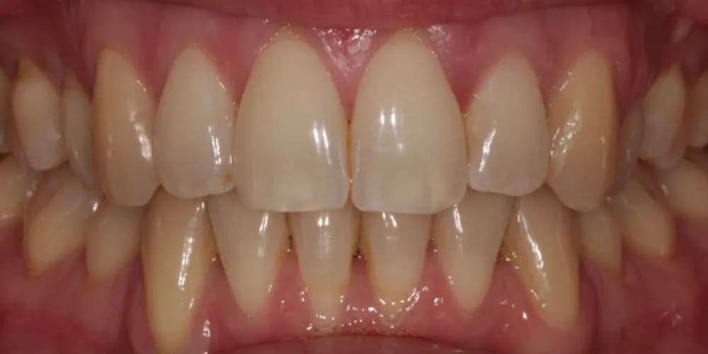 Before: a patient's front teeth, treated with professional whitening