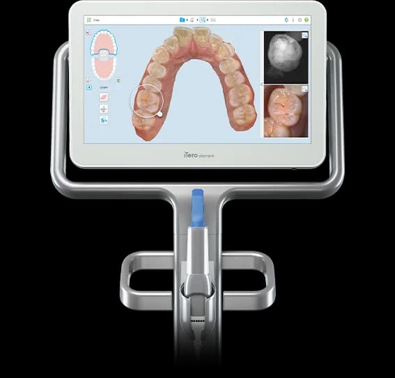 An iTero Element digital scanner showing a 3D scan of a patient's teeth